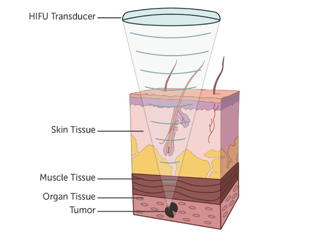 CTS Piezoceramic Transducer Tumor Treatment