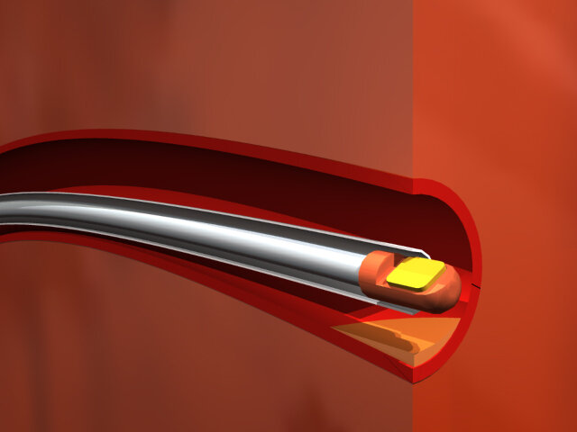 A piezoelectric transducer mounted on a intravascular ultrasound probe